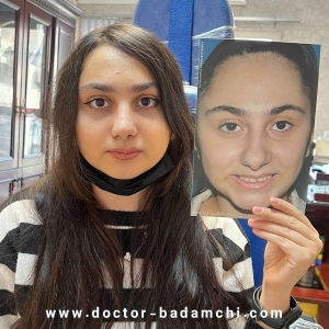 rhinoplasty-120
