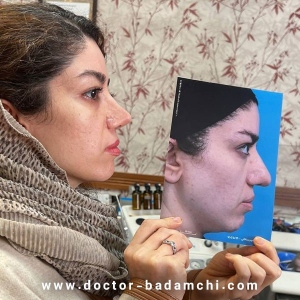 rhinoplasty-121