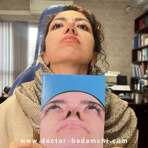 rhinoplasty-122