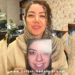 rhinoplasty-123