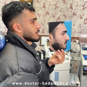 rhinoplasty-124