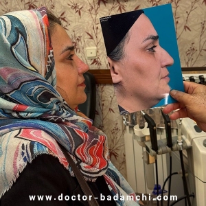 rhinoplasty-125