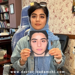 rhinoplasty-126
