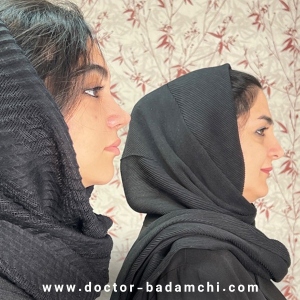 rhinoplasty-127