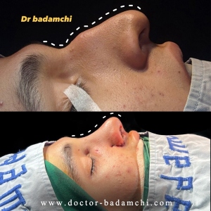 rhinoplasty-128