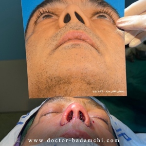 rhinoplasty-129
