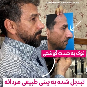 rhinoplasty-130