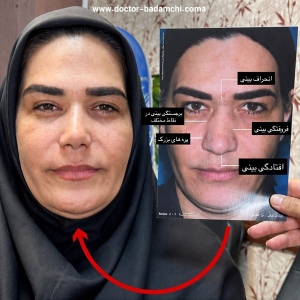 rhinoplasty-133
