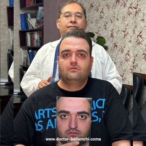 rhinoplasty-135