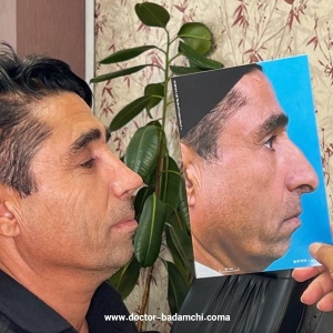 rhinoplasty-136
