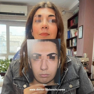 rhinoplasty-137