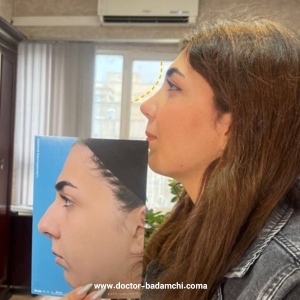 rhinoplasty-138