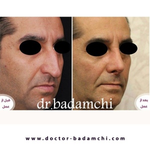 rhinoplasty-139