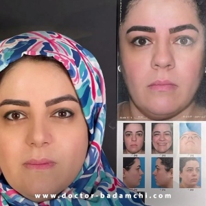 rhinoplasty-140