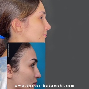 rhinoplasty-141