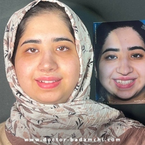 rhinoplasty-142