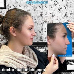 rhinoplasty-83