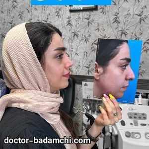 rhinoplasty-84