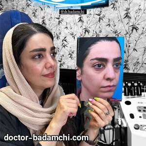 rhinoplasty-85