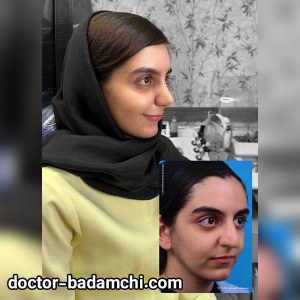 rhinoplasty-86