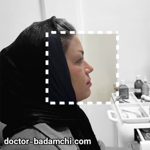 rhinoplasty-87