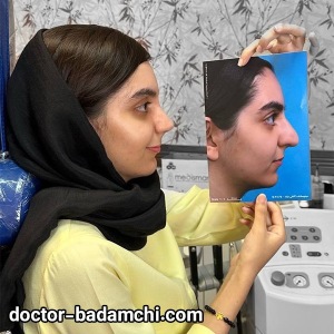 rhinoplasty-88