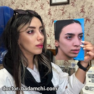 rhinoplasty-89