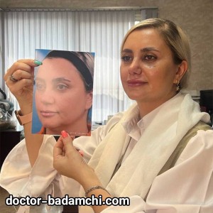 rhinoplasty-90