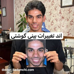 rhinoplasty-92