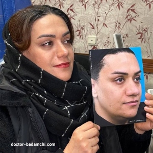 rhinoplasty-93