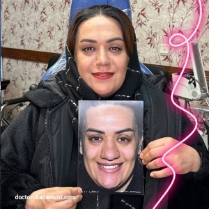 rhinoplasty-94