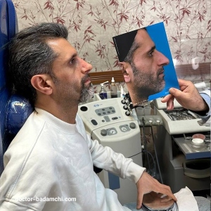 rhinoplasty-99
