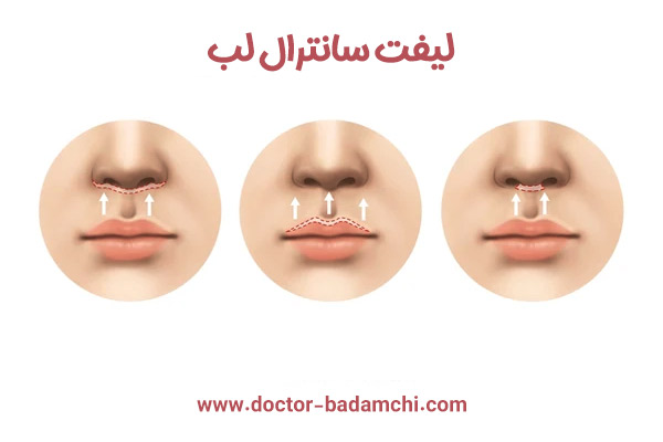  لیفت سانترال لب + دکتر بهرام بادامچی