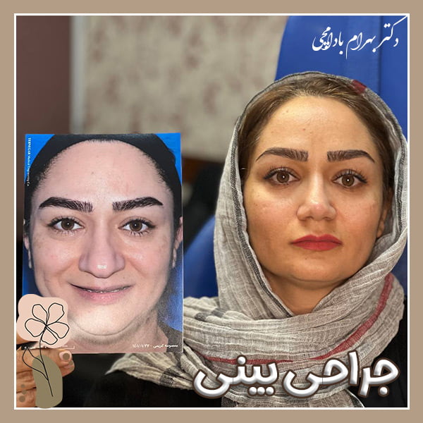 جراحی بینی - دکتر بهرام بادامچی
