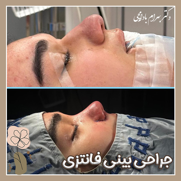جراحی بینی فانتزی + دکتر بهرام بادامچی