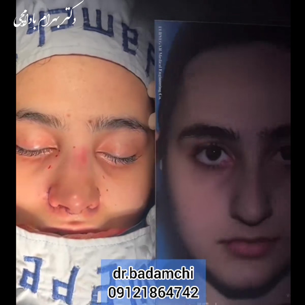 بینی فانتزی از رو به رو