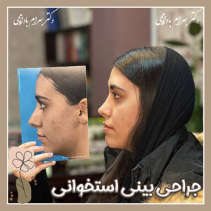 جراحی بینی استخوانی + دکتر بادامچی