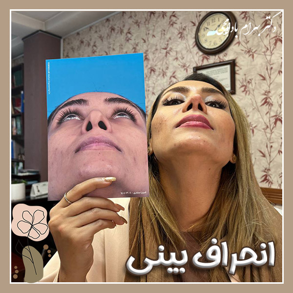 انحراف بینی + دکتر بهرام بادامچی