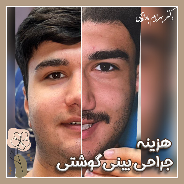 هزینه عمل بینی گوشتی در تهران + دکتر بهرام بادامچی