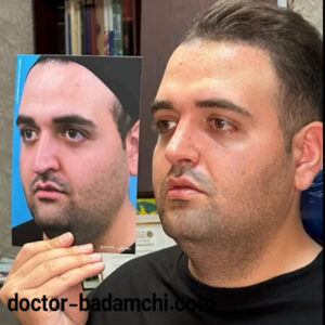 نمونه کار عمل بینی طبیعی دکتر بادامچی