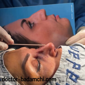 نمونه کار عمل بینی طبیعی دکتر بادامچی
