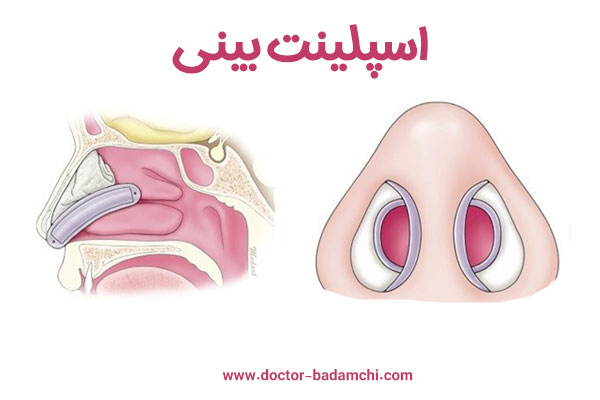 اسپلینت بینی - دکتر بهرام بادامچی