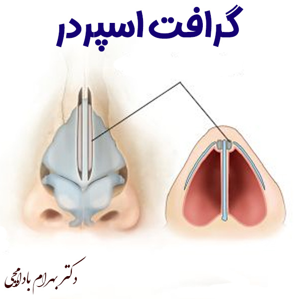 گرافت بینی اسپریدر