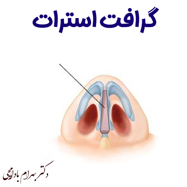 گرافت بینی استرات