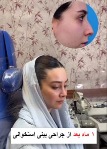 عکس عمل بینی استخوانی طبیعی - doctor-badamchi.com