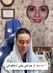 عکس عمل بینی استخوانی طبیعی - doctor-badamchi.com