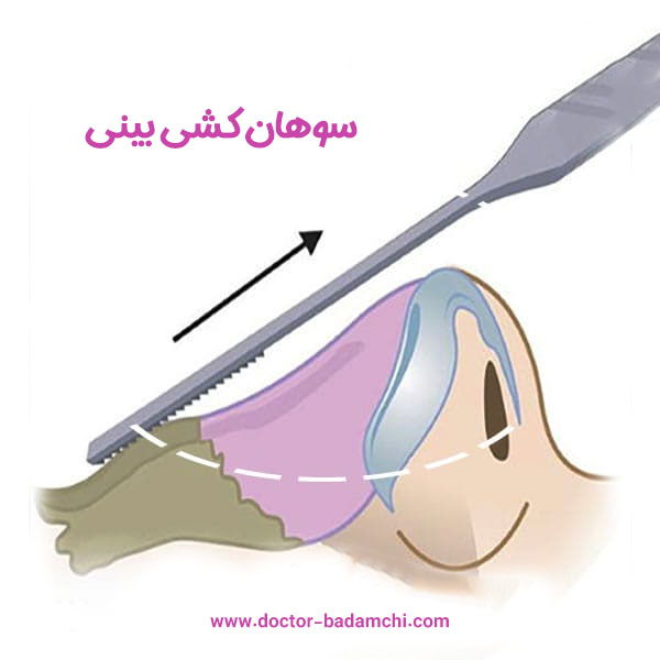 سوهان کشی بینی + دکتر بهرام بادامچی