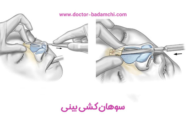 سوهان کشی بینی + دکتر بهرام بادامچی
