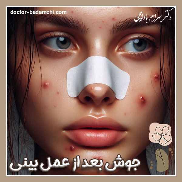 جوش زدن بعد از عمل بینی + دکتر بهرام بادامچی