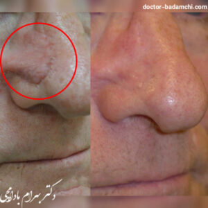 عکس گوشت اضافه بینی